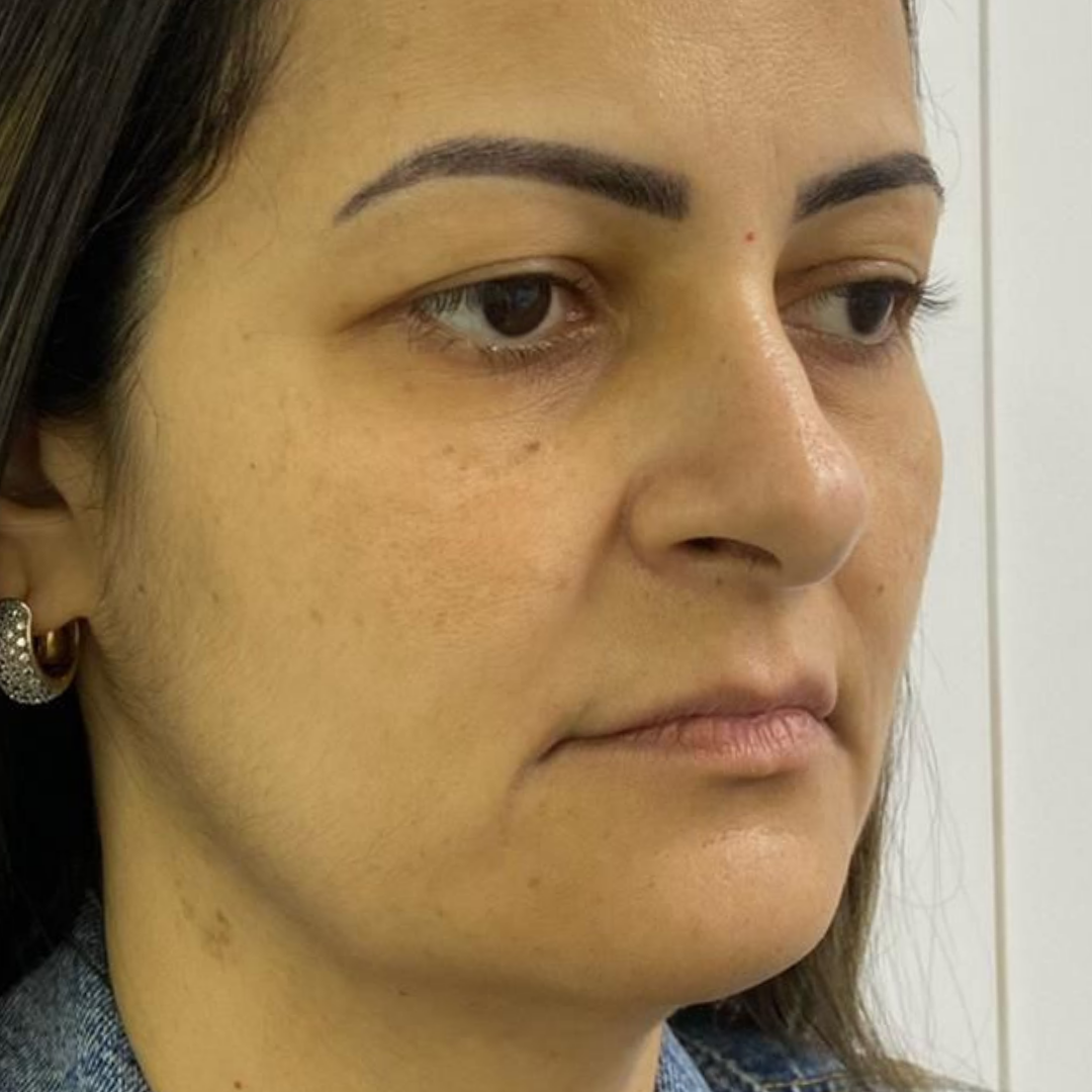 Depois do procedimento 4